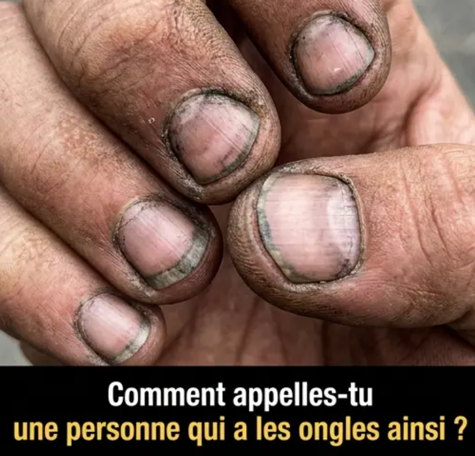 Comment appelle-t-on une personne qui a des ongles comme ça ?