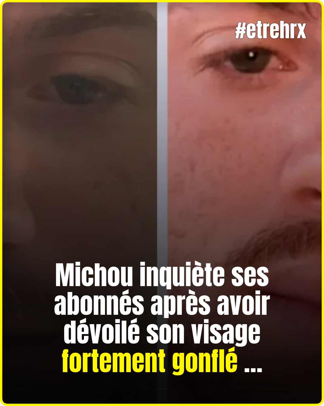Michou : son visage déformé, “ça continue à gonfler”