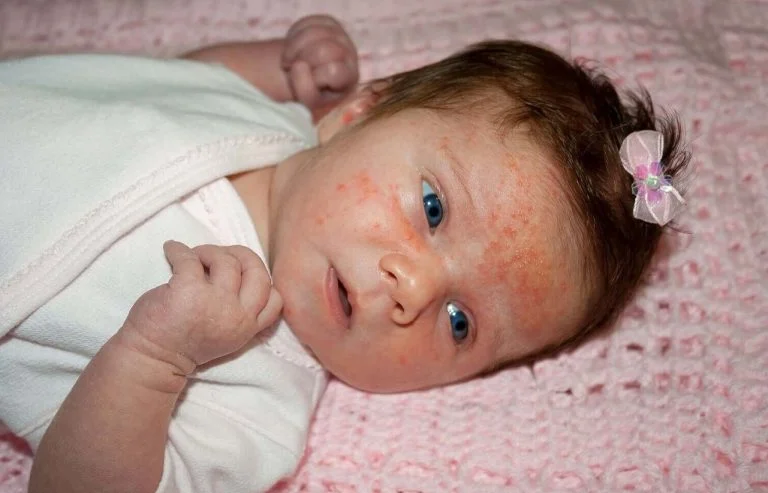Eczéma chez bébé (2)