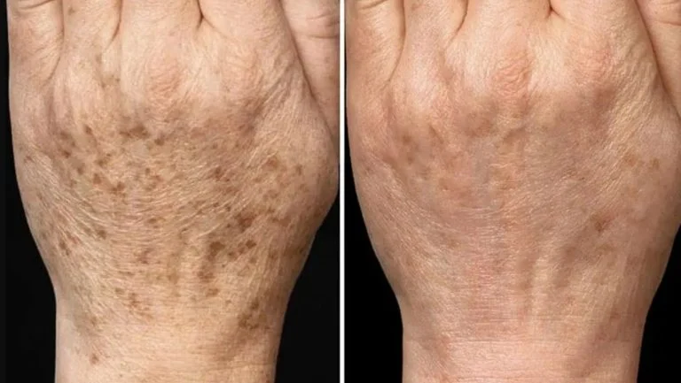 Taches brunes sur les mains (1)