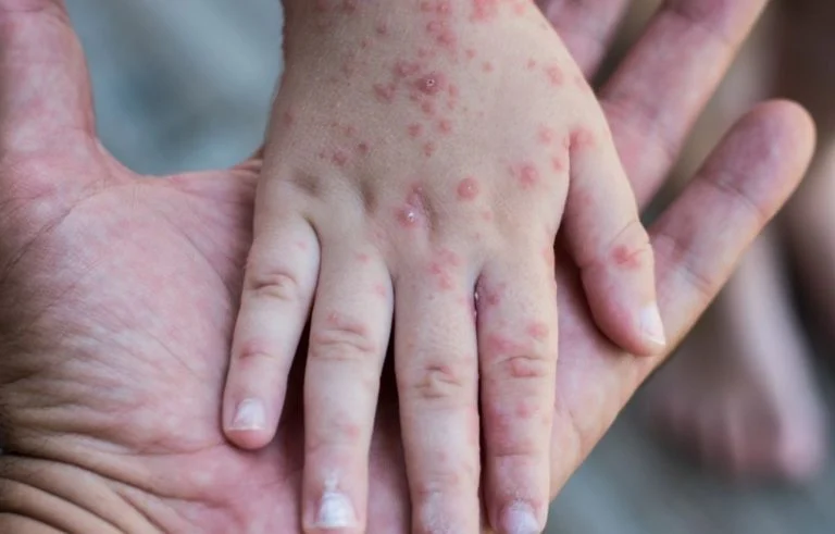 cloques sur les mains et les pieds (5)