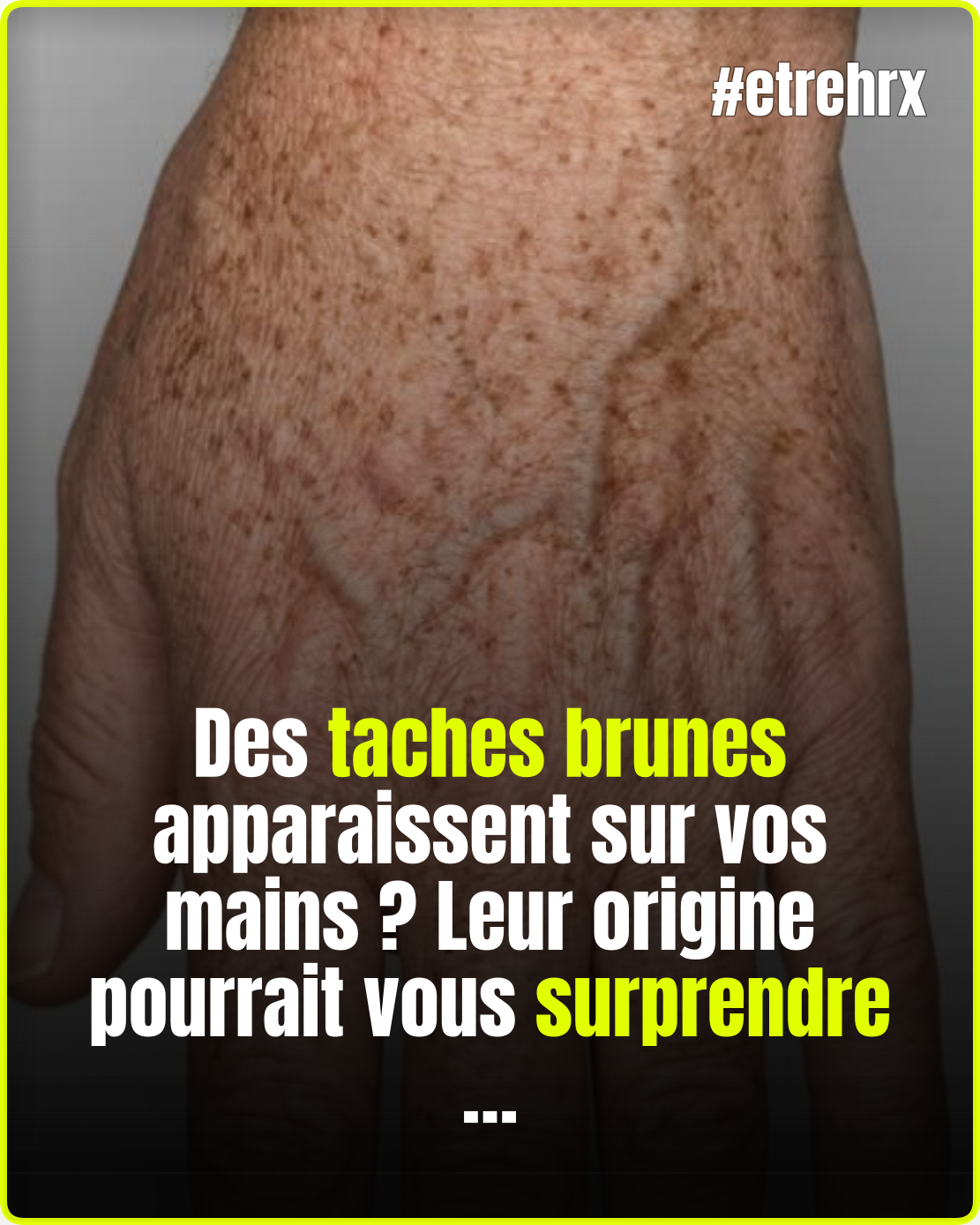 Ces taches sur les mains ne sont pas toujours liées à l\'âge…