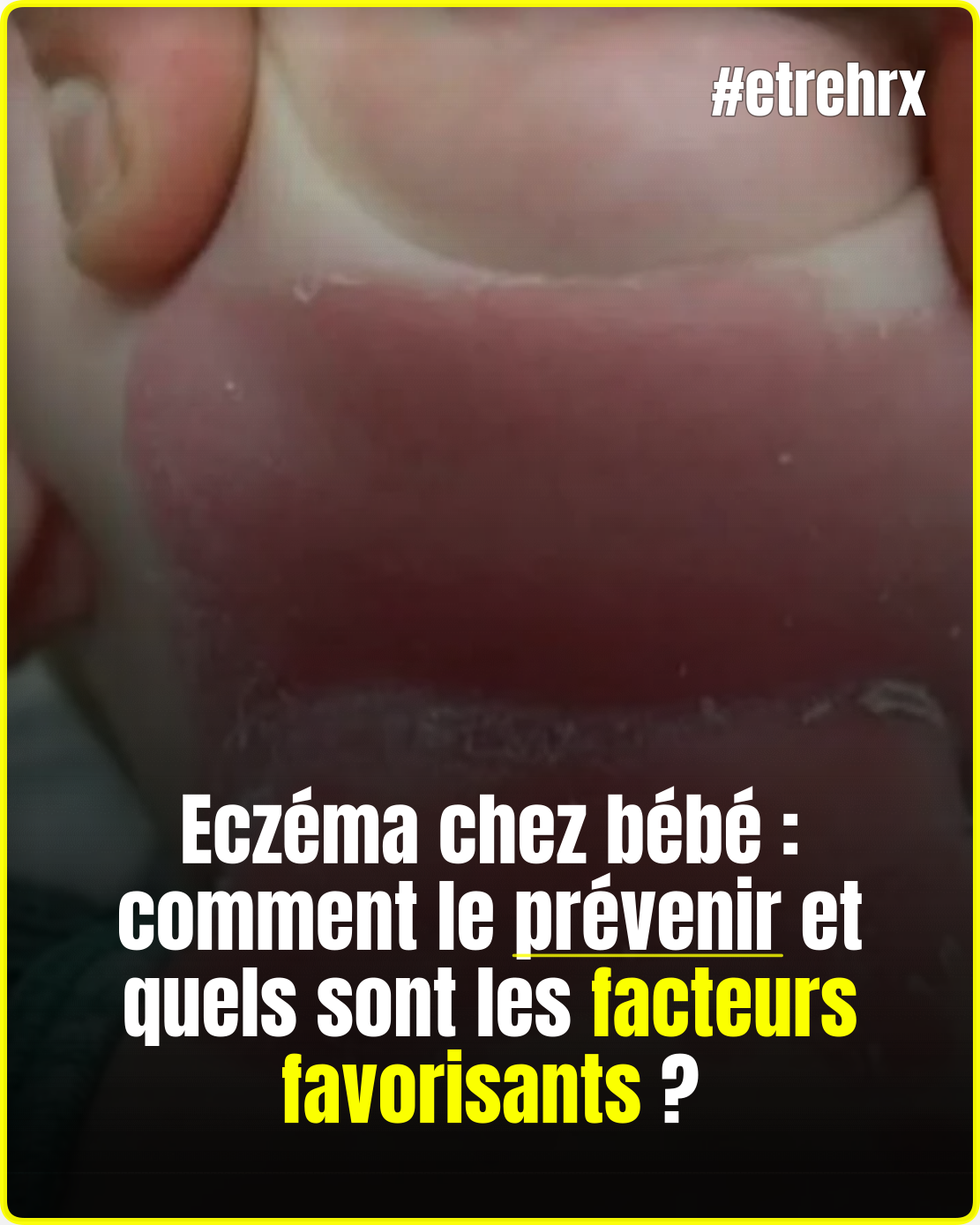 Votre bébé souffre d’eczéma ? Ces facteurs souvent méconnus pourraient favoriser les poussées…
