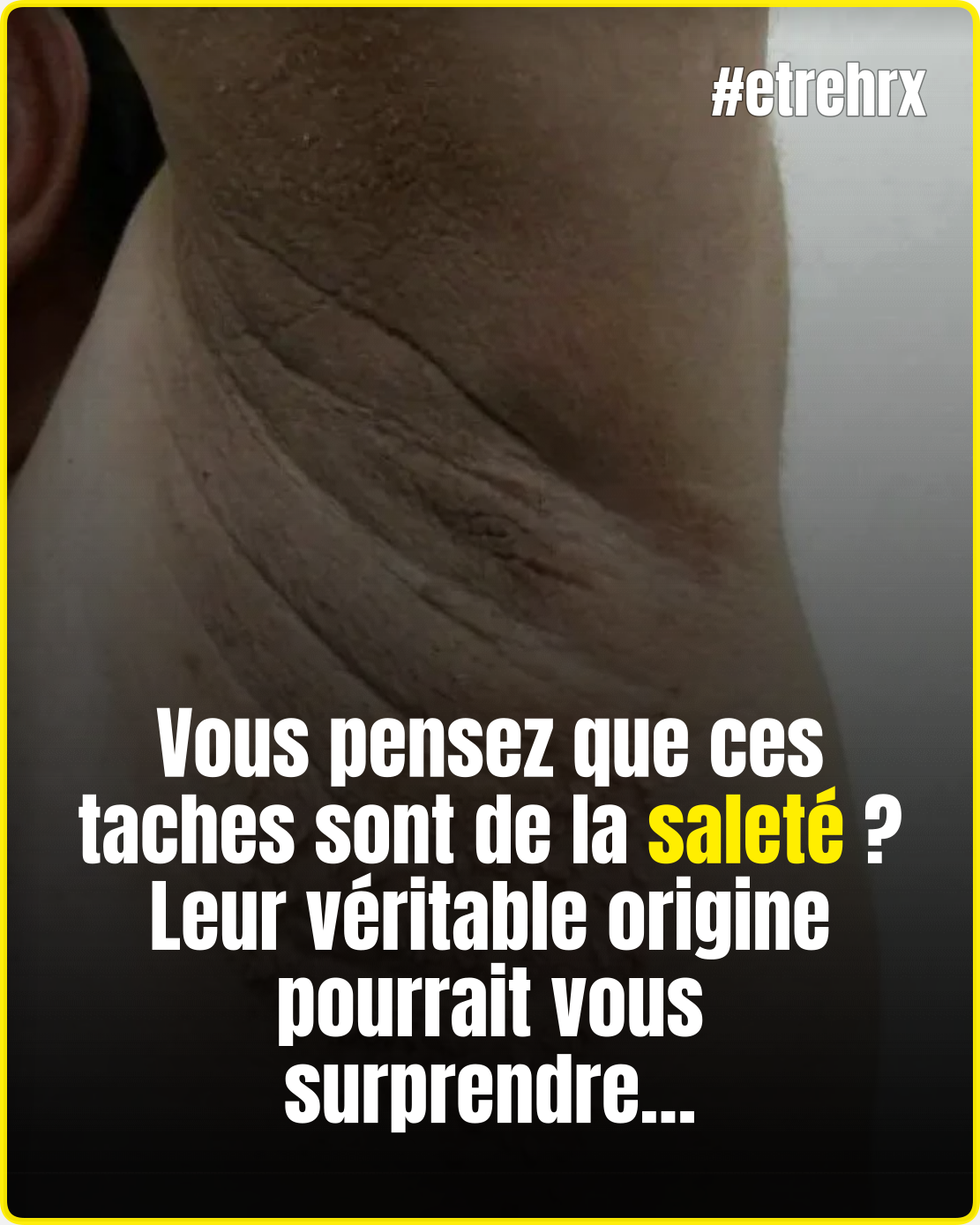 Ces taches foncées sur la peau que l’on prend pour de la