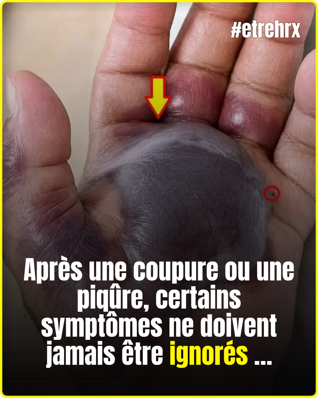 Coupure, piqûre d’insecte : les premiers signes d’infection que vous ne devriez