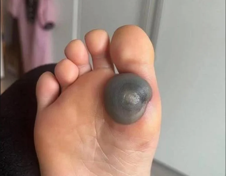 une grosse tache sur le pied (3)