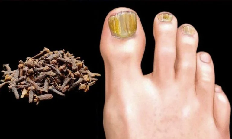 champignons des ongles (2)