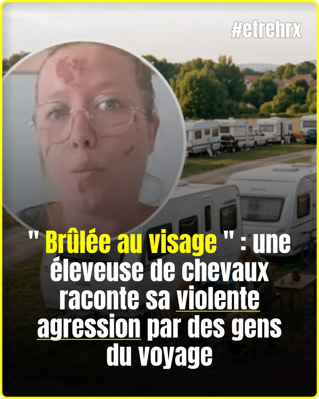« Brûlée au visage » : une éleveuse de chevaux raconte sa