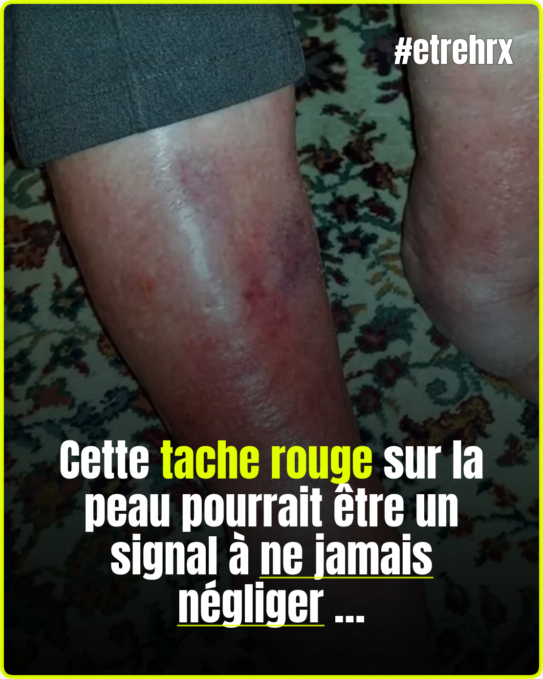 Cette tache rouge sur la peau que vous ne devriez jamais ignorer