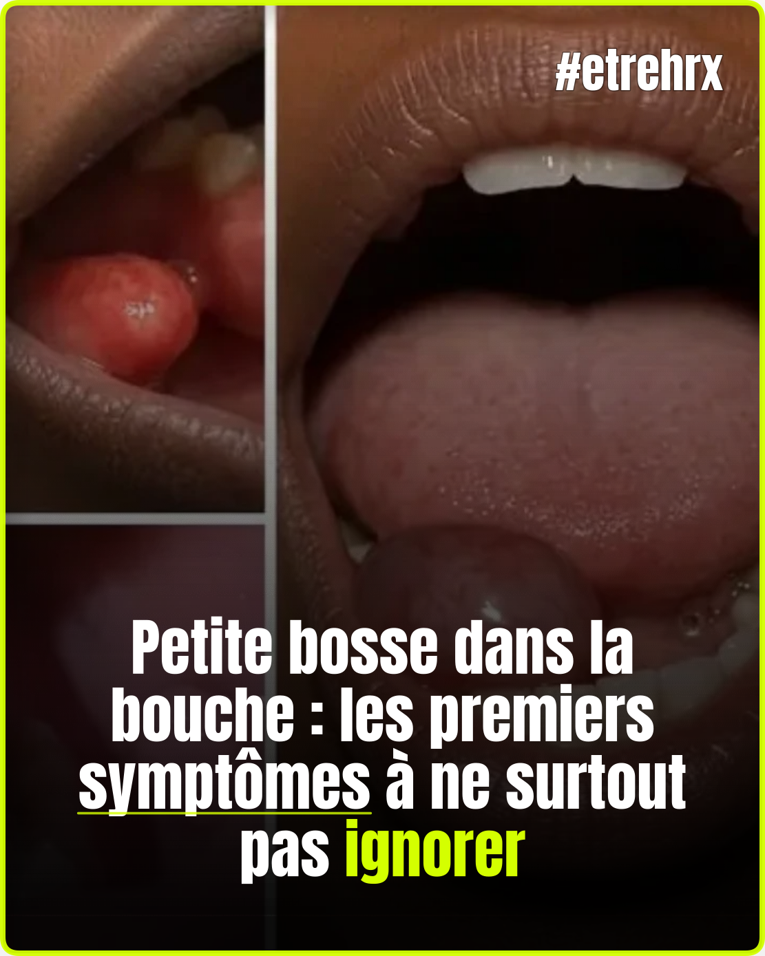 Petite bosse dans la bouche : les premiers symptômes à ne surtout