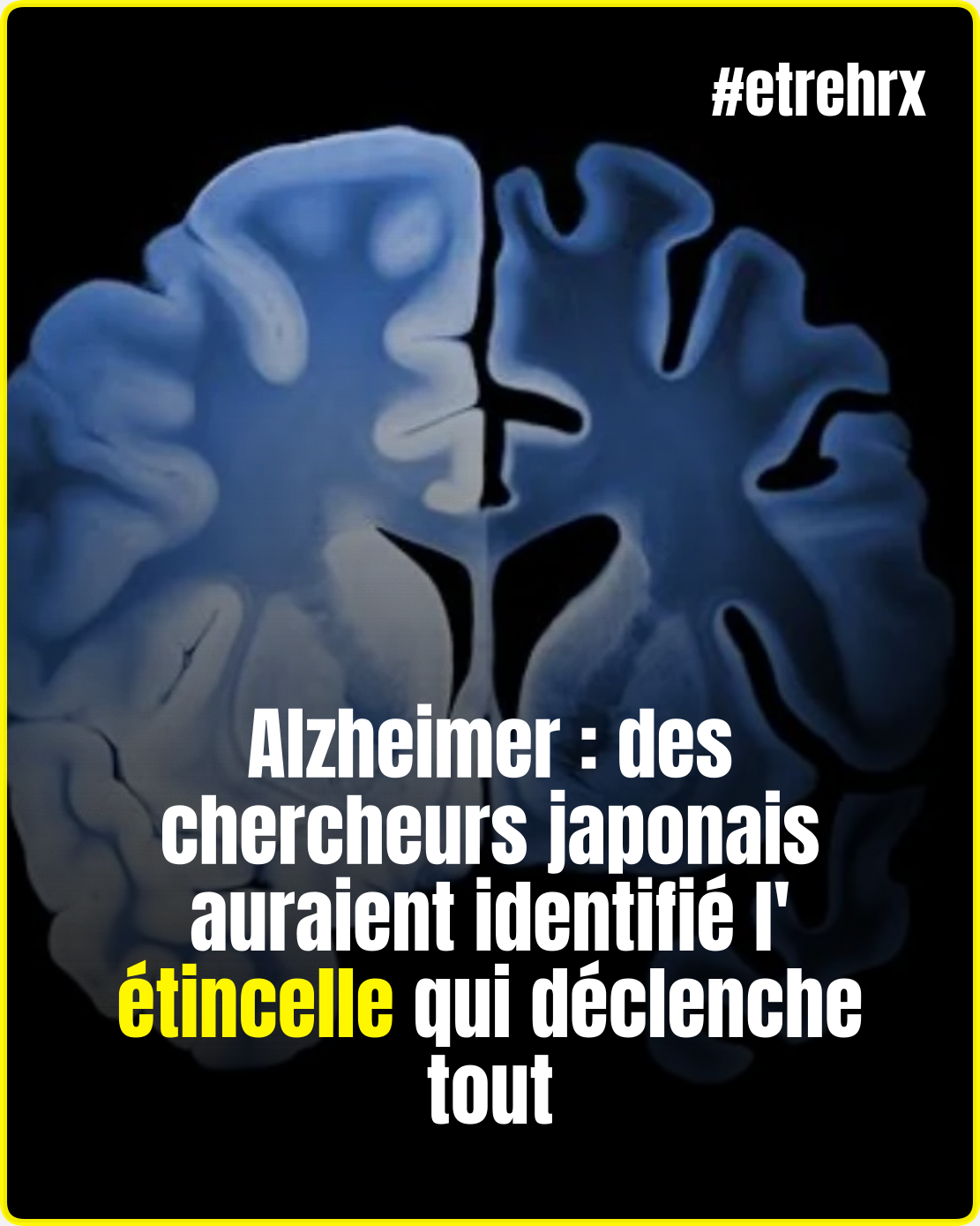 Alzheimer : des chercheurs japonais auraient identifié l’étincelle qui déclenche tout