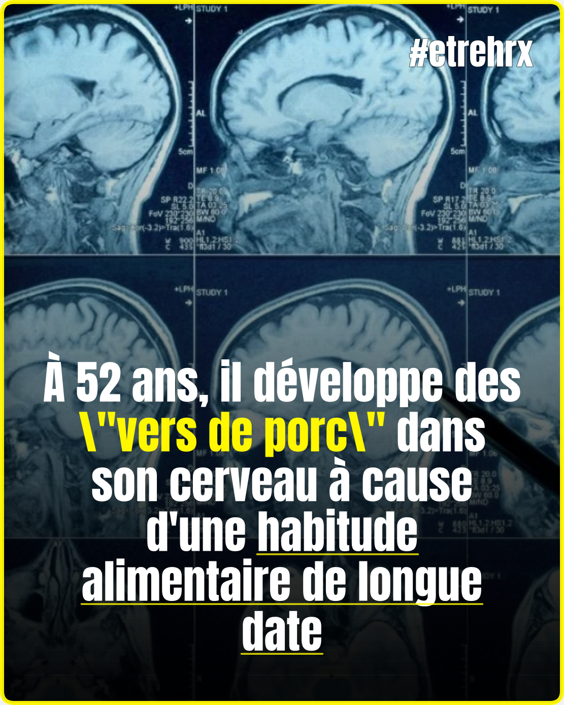 À 52 ans, il développe des « vers de porc » dans