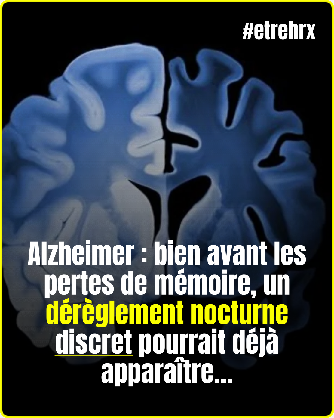 Alzheimer : ce dérèglement nocturne caché commence bien avant les pertes de mémoire