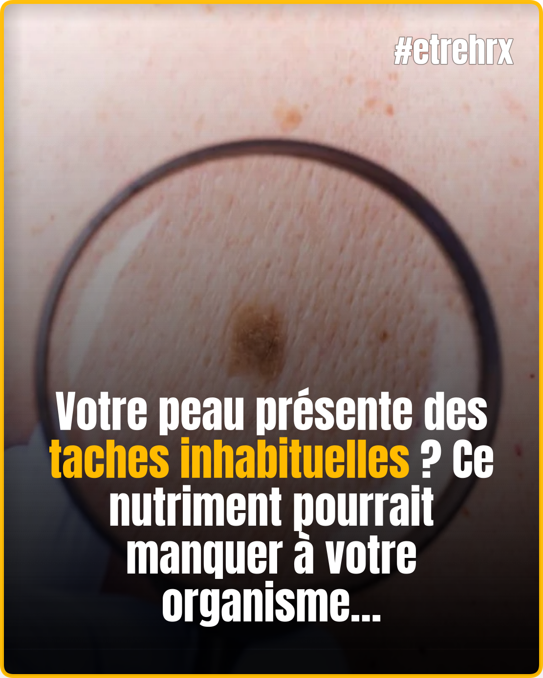La carence en cet élément peut provoquer des taches cutanées inattendues