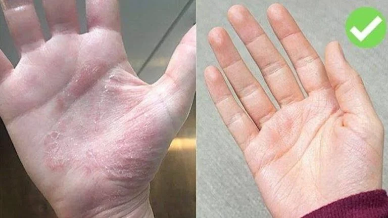 eczéma (5)
