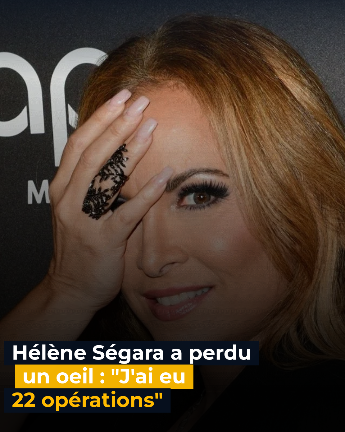 Hélène Ségara a perdu un oeil : « J&rsquo;ai eu 22 opérations »