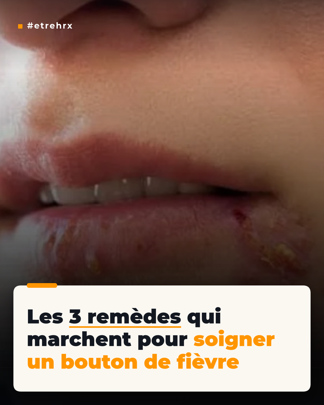Les 3 remèdes qui marchent pour soigner un bouton de fièvre
