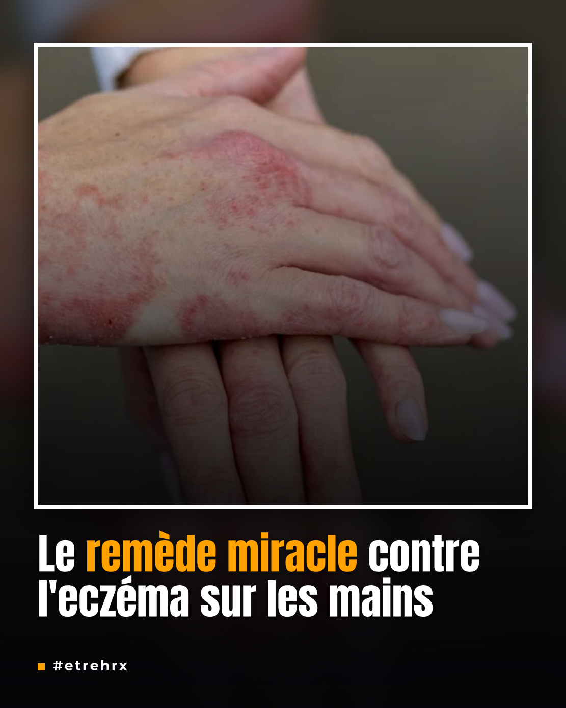 Mains sèches et eczéma, voici la solution...